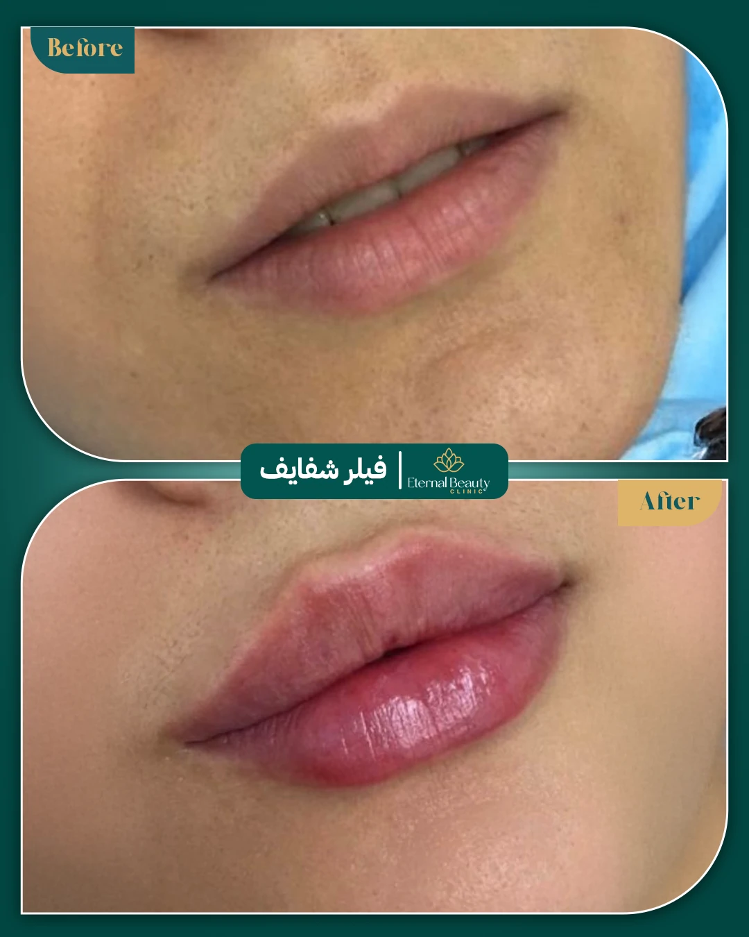 حالات فيلر شفايف قبل وبعد - عيادات ايترنال بجدة (1)