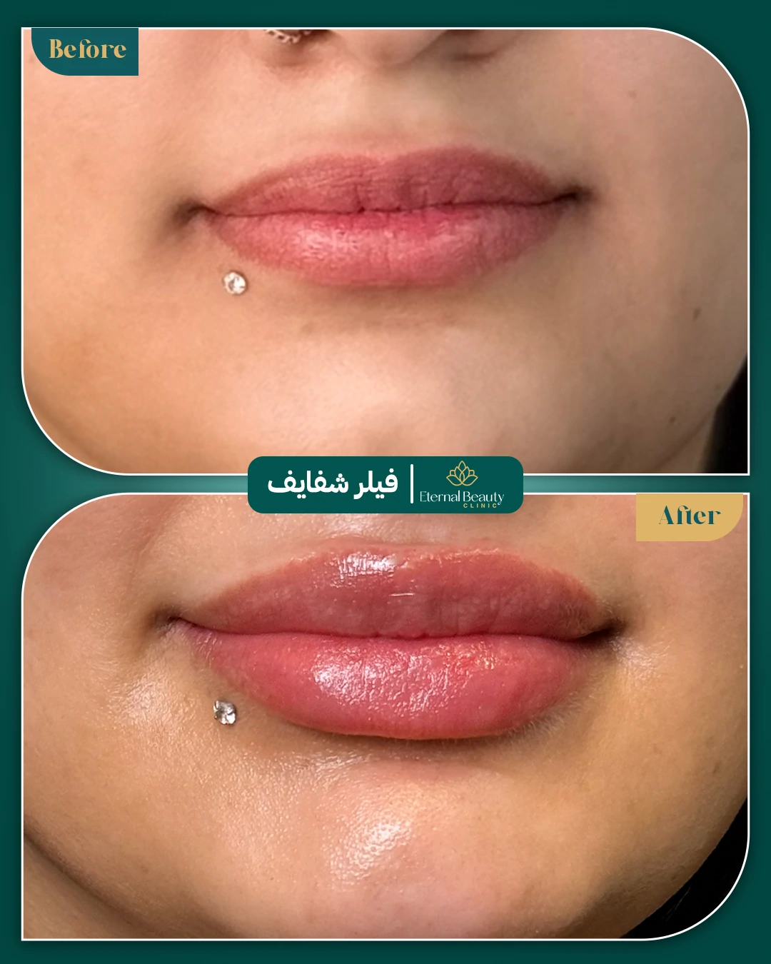حالات فيلر شفايف قبل وبعد - عيادات ايترنال بجدة (2)