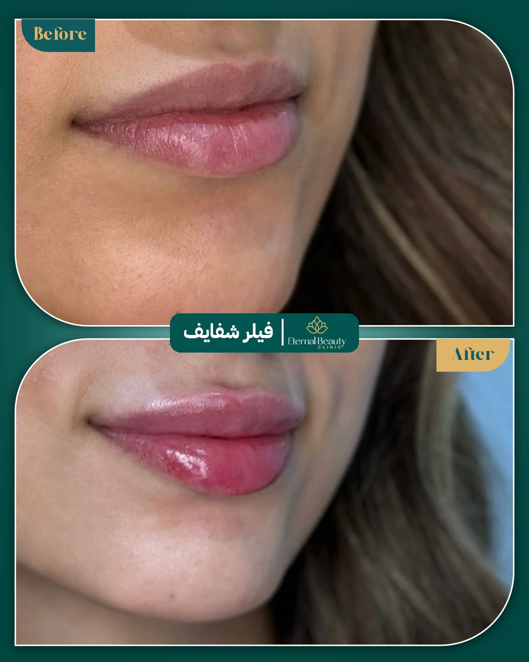 حالات فيلر شفايف قبل وبعد - عيادات ايترنال بجدة (3)