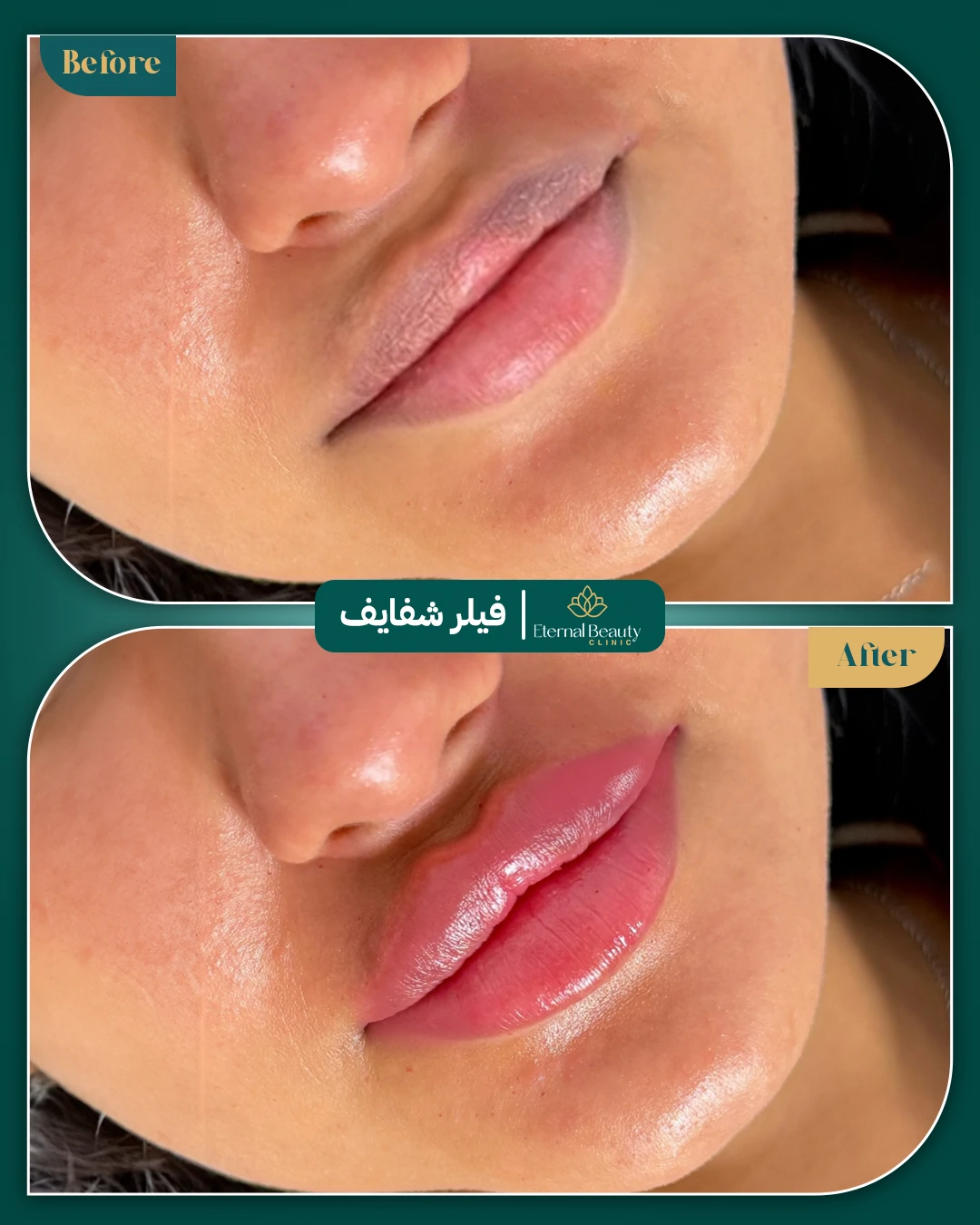 حالات فيلر شفايف قبل وبعد - عيادات ايترنال بجدة (4)