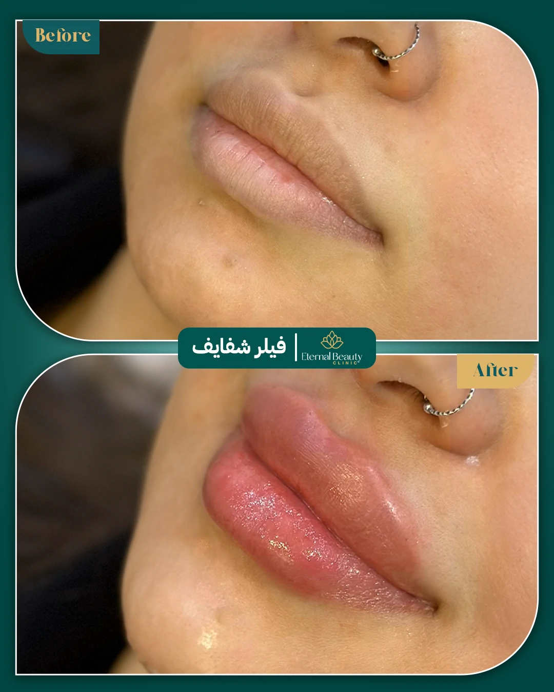 حالات فيلر شفايف قبل وبعد - عيادات ايترنال بجدة (5)