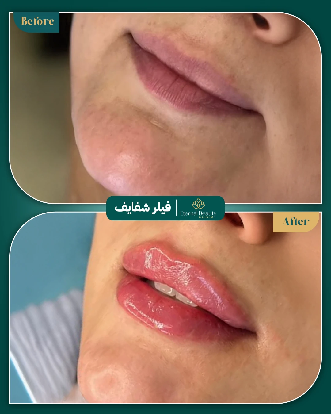 حالات فيلر شفايف قبل وبعد - عيادات ايترنال بجدة (6)