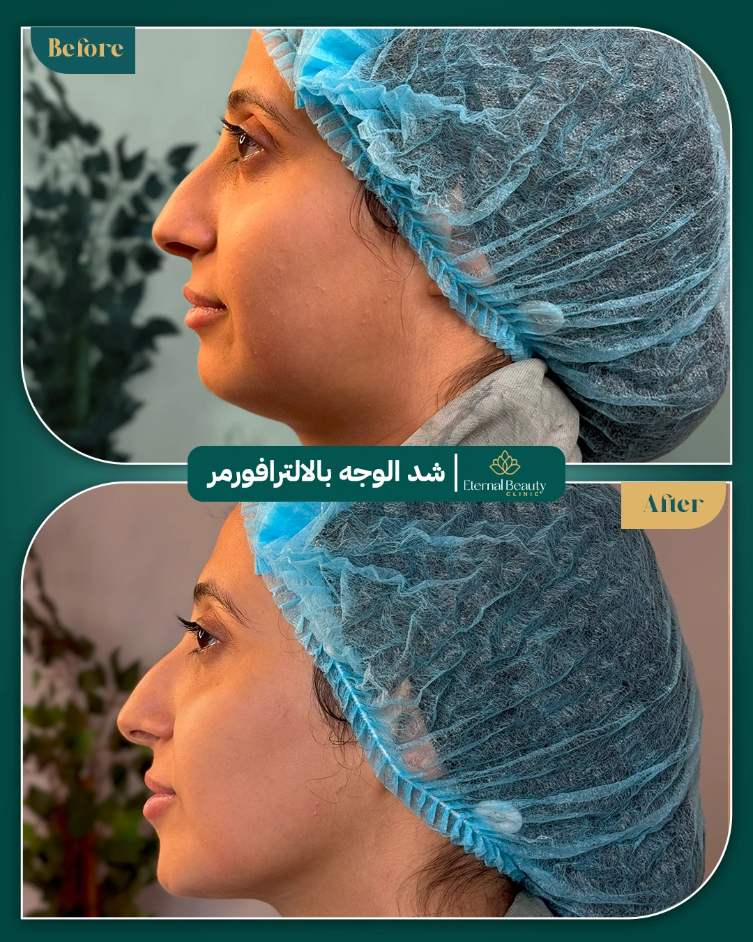 حالات فيلر شفايف قبل وبعد - عيادات ايترنال بجدة (7)