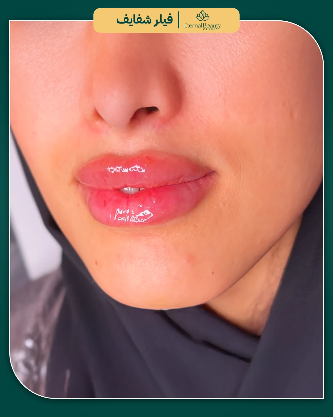 حالات فيلر شفايف قبل وبعد - عيادات ايترنال بجدة (8)